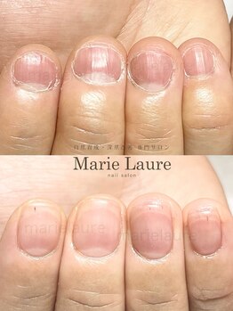 マリーロール 梅田店(Marie Laure)/自爪育成/深爪矯正/ネイルケア