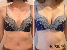 リール 新宿店(RIRE)/40代前半　 バストアップ症例