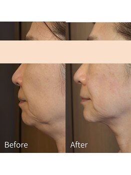 ルマ(Rumah)/むくみ・たるみ改善に◎