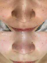 アネラ(anela)/ハイドラ毛穴洗浄(全顔)