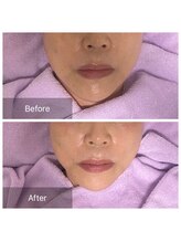 サロン ド パーフェクション(Salon de Perfection)/小顔リフト