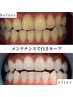 【白さ持続力No1☆】超美白セルフホワイトニング40分×20回照射 ¥96000