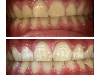 ディーバッカス(D Bacchus)/ホワイトニングビフォーアフター