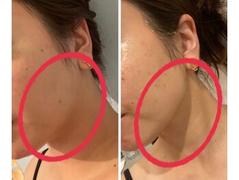 ルナグランデ(Luna grande.)/脂肪分解5ml 1回で輪郭が…!!