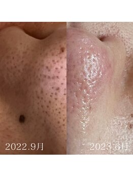 ジェリー(JERRY)/毛穴改善