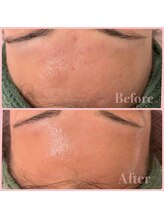 ウル 下北沢(Ulu)/REVIハーブピーリング