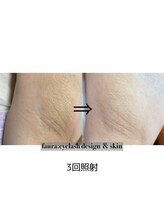 ファウラ(faura:)/ワキ脱毛