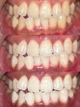 ラヴィス(RAVIS)/歯が白いって素敵♪