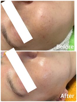 シロ チューズミー(Shiro choose me)/剥けないハーブピーリング