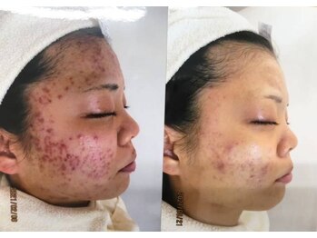 ザ フェース 梅田店(THE FAITH)/◆お肌変化写真◆