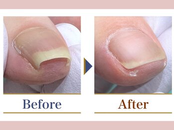 巻き爪補正店 大阪なんば店/巻き爪 1箇所