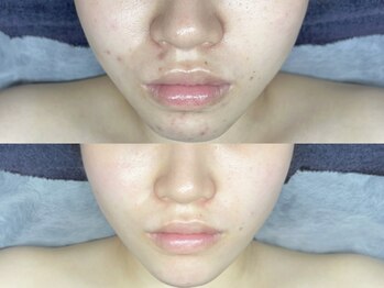 エモーショナル 姫路(Emotional)/ララピールLDM8回【ニキビケア】