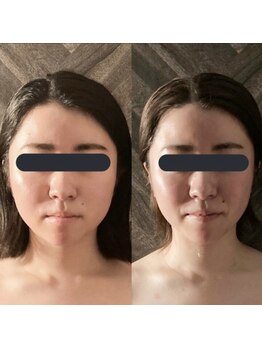 ハイコガオ 中崎町店(HIKOGAO)/小顔矯正