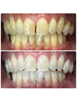 トータルビューティー エヌ プラス(total beauty n+)/Before ⇒ After