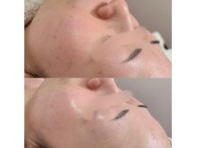 オンド(OND)の雰囲気(くすみ 肌荒れ 毛穴悩み 肌の不安定な方攻めずに土台からケアを)