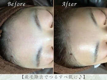 サラリ ビューティー ラウンジ(Sarari BEAUTY LOUNGE)/お顔脱毛!!美肌効果抜群!!