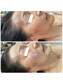 武蔵小杉リンパサロン かおりの部屋/リアボーテ・ハーブピーリング