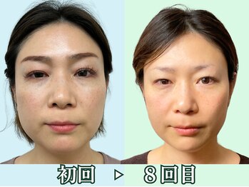 ナチュラルビューティーフェイス 横浜(NBF)/４０代ビフォーアフター