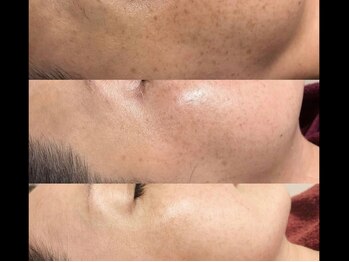 ミルジュ(MiLuJu)/ハーブトリートメント3回の変化