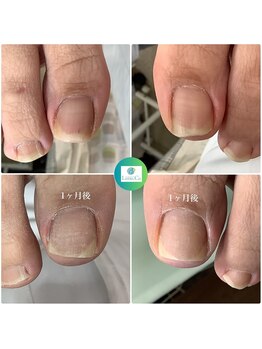 リゼラアンドコー 池袋店/巻き爪補正