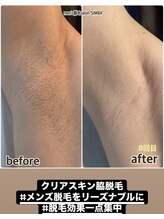 シンバ 倉敷店(SIMBA)/【臭いの元】クリアスキン脇脱毛