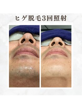 ボゴス(BOGOSS)/ヒゲ脱毛5回照射