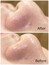 ハクミー(haku me)/☆鼻毛穴の汚れ黒ずみの変化☆