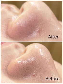 ハクミー(haku me)/☆鼻毛穴の汚れ黒ずみの変化☆