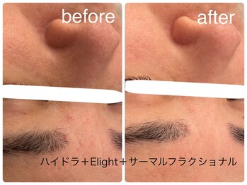 メゾンリュバン 梅田店(Maison Ruban)/毛穴洗浄・美白フォト|毛穴ケア