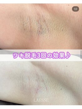 ラエッセ(LAESSE)/黒いポツポツさよなら☆彡