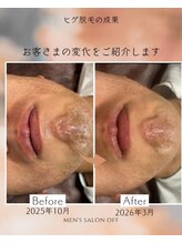 オフ(off)/ヒゲ脱毛