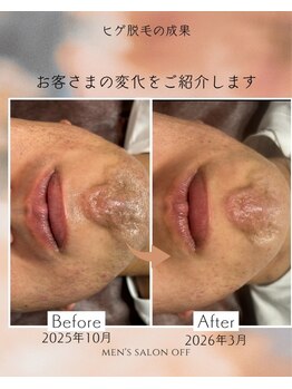 オフ(off)/ヒゲ脱毛