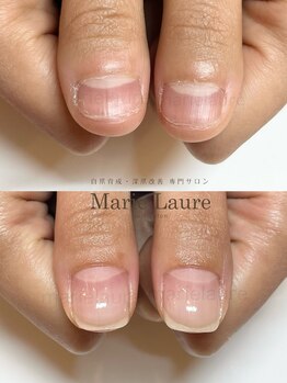 マリーロール 淀屋橋本店(Marie Laure)/自爪育成/深爪矯正/ネイルケア