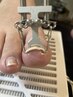 【FOOT】巻き爪ケア♪痛み緩和カウンセリング込み★1本/¥5500 