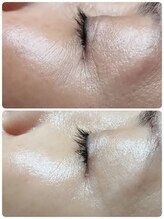 スムース イー(Smooth+E)/マイクロニードル美容液浸透施術