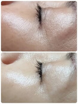 スムース イー(Smooth+E)/マイクロニードル美容液浸透施術