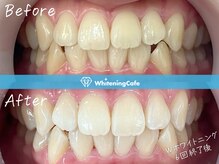 ホワイトニングカフェ 原宿店/◎歯のホワイトニング施術写真◎