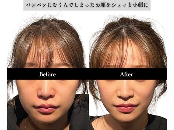 アロエベル(aloe Belle)/Before After（4回施術）