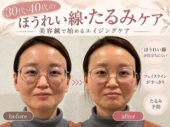 ソラナ(Solana)の写真/たるみ、ホウレイ線でお悩みの方に☆お顔の印象を変えたい方にオススメ！美容鍼灸でお肌のお悩みを徹底改善