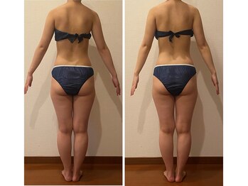 うつくし痩身 美サロン ゼットワン(Z-ONE)/メディセル１回　before　after