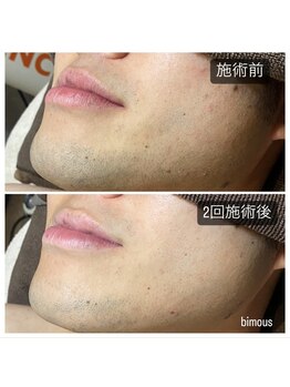 ビモアス(bimous)/メンズヒゲ脱毛