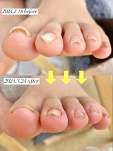 ニコワイズネイル(Nico Y's Nail)/【巻き爪緩和コース】