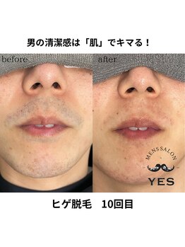 イエス 久留米店(YES)/ヒゲ脱毛ビフォーアフター