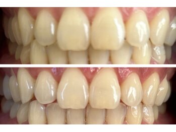 コハク(kohaku)/セルフホワイトニングリピート