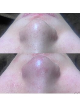 ナチュウル(Natulu)/ハイドラ毛穴洗浄◇お鼻の黒ずみ