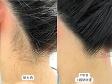 セルフメイド 東大阪店(SELFMADE)/うなじ脱毛♪BeforeAfter