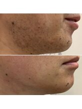 エピシアドットエヌ(epicia.N)/脱！青ヒゲ！