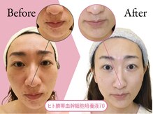 クリニカルエステ イーズ 三宮店の雰囲気（再生美容☆ヒト臍帯血順化培養液エレクトロポレーション導入）