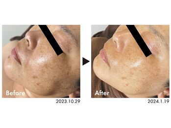 ピオラ(Piora)/ホワイトスノーピール/6回