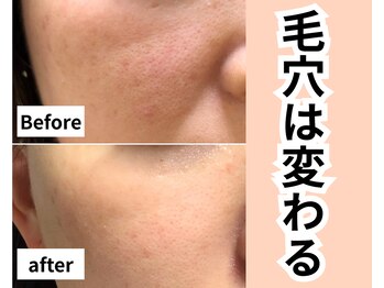 リアン(LIAN)/毛穴改善プレミアムコース